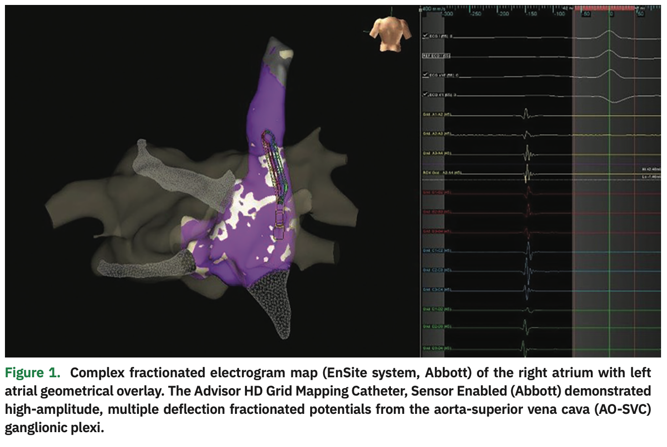 Lorvidhaya Cardioneuroablation Figure 1