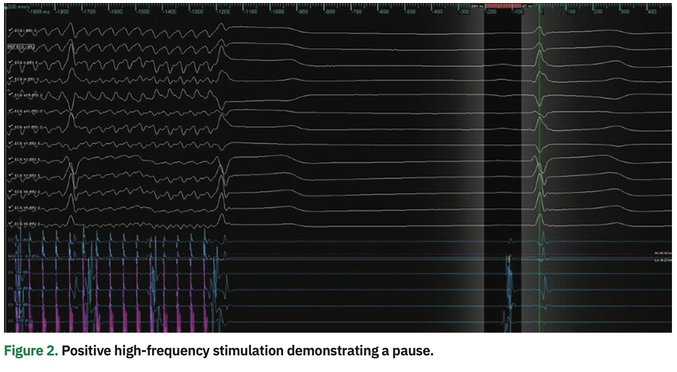 Lorvidhaya Cardioneuroablation Figure 2