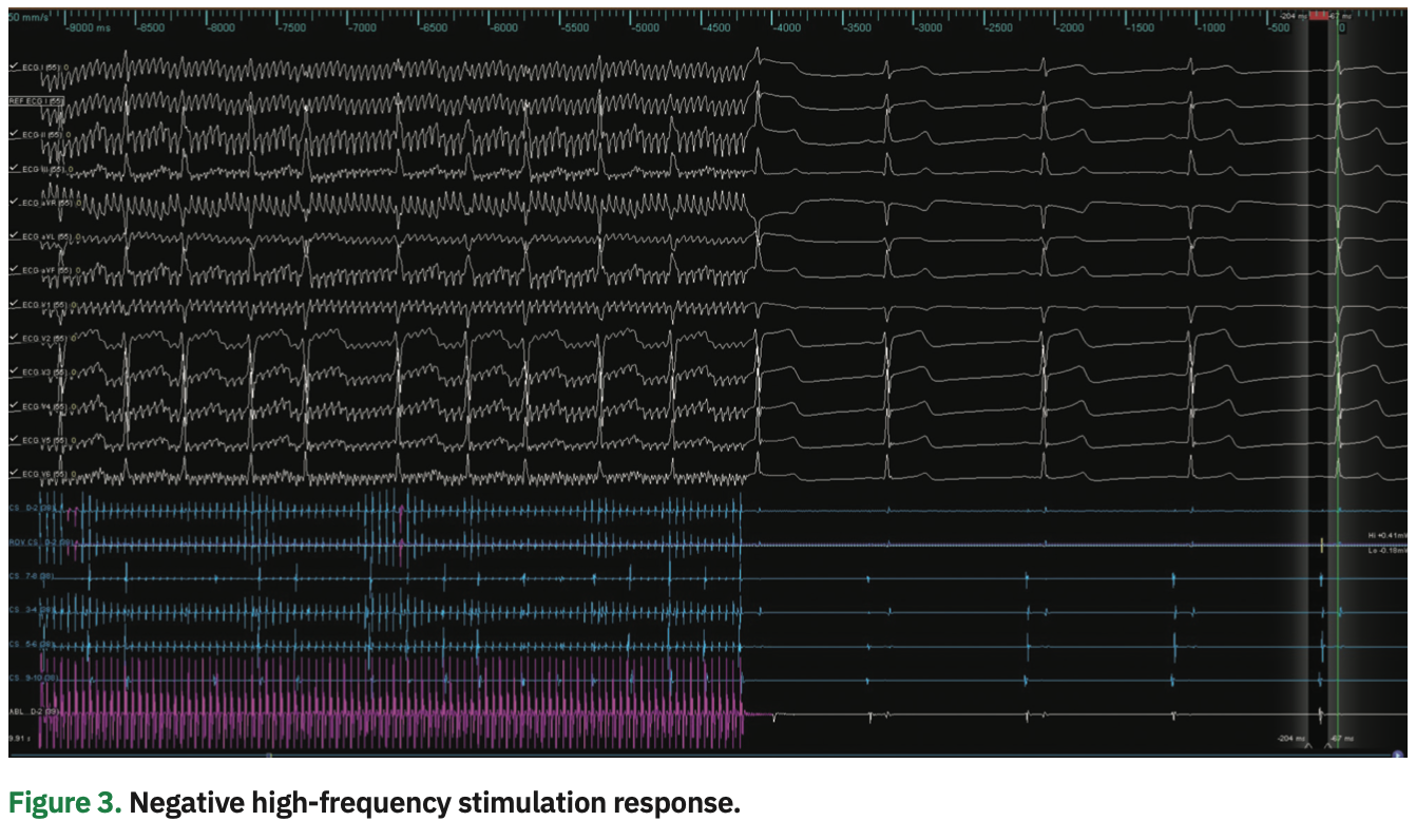 Lorvidhaya Cardioneuroablation Figure 3
