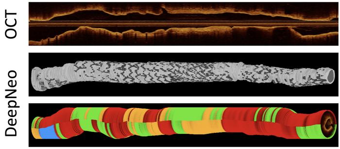 The top panel shows a cross-sectional view of a 3D OCT scan consisting of more than 300 single images. In the middle, DeepNeo segments the image into background, lumen, neointima, and stent. The bottom panel shows DeepNeo’s classification: blue indicates non-analyzable regions, green marks homogeneous neointima, orange denotes heterogeneous tissue, and red highlights neoatherosclerosis.  Credit Helmholtz Munich / Valentin Koch