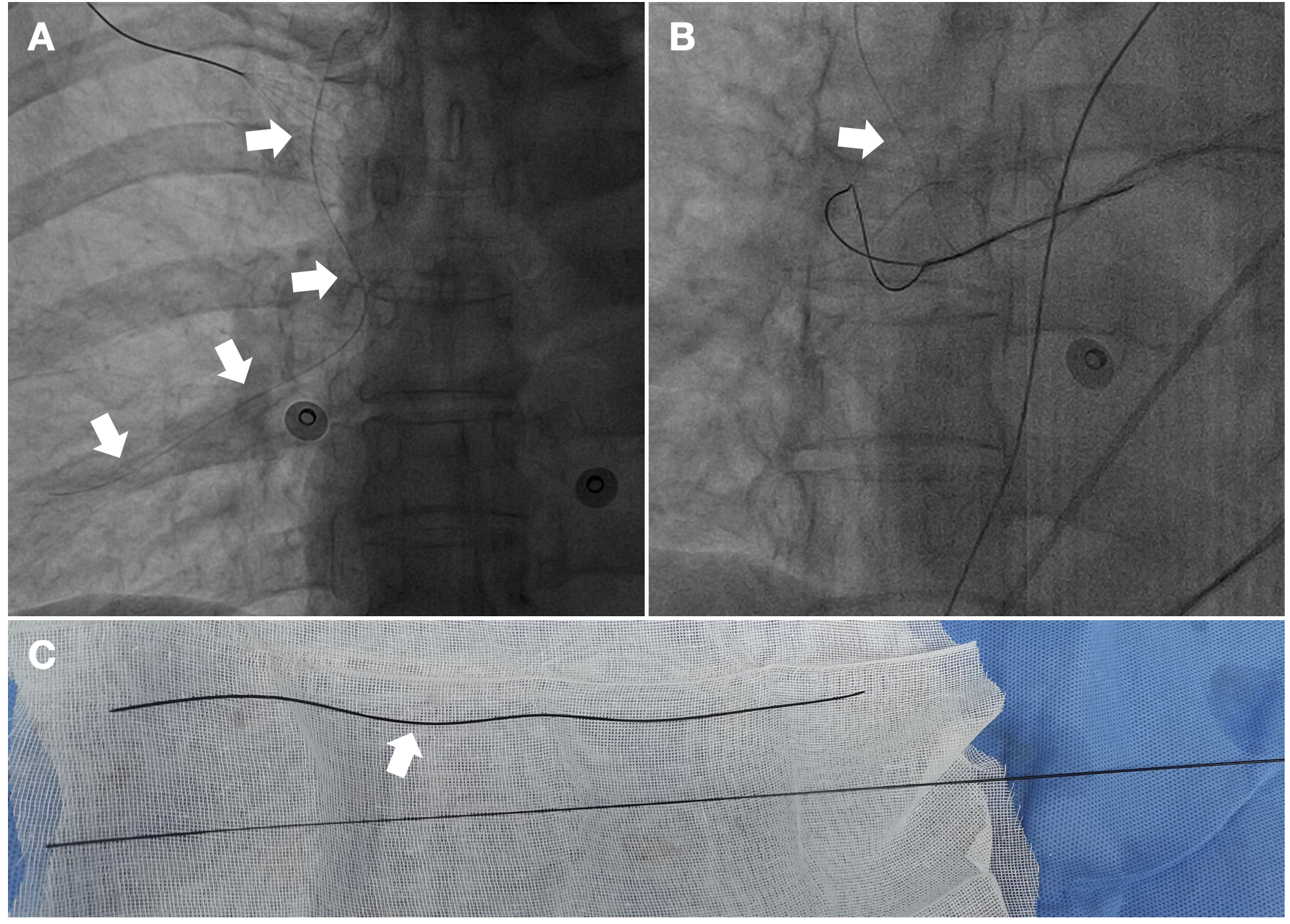 Figure. Hydrophilic coating was stripped from the puncture guide wire