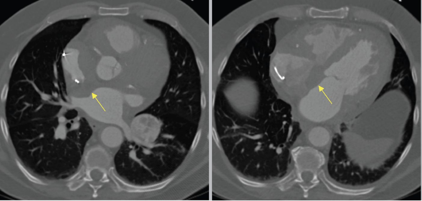 Lugo Fagundo RA Biopsy Endobronchial Forceps Fig 1
