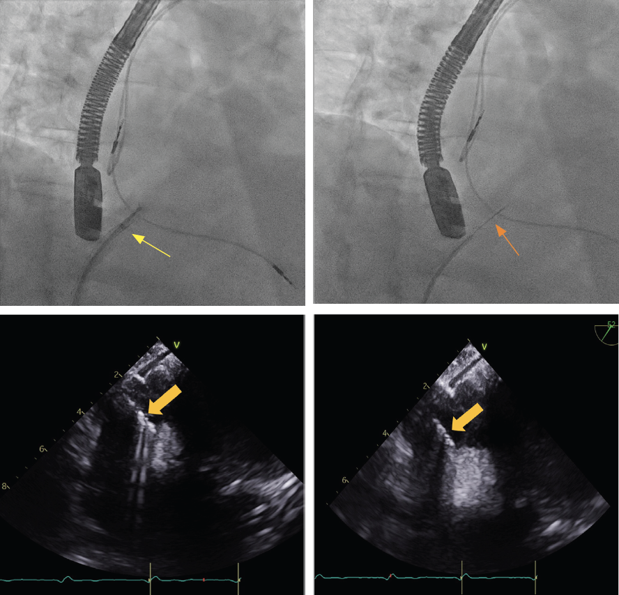Lugo Fagundo RA Biopsy Endobronchial Forceps Fig 2