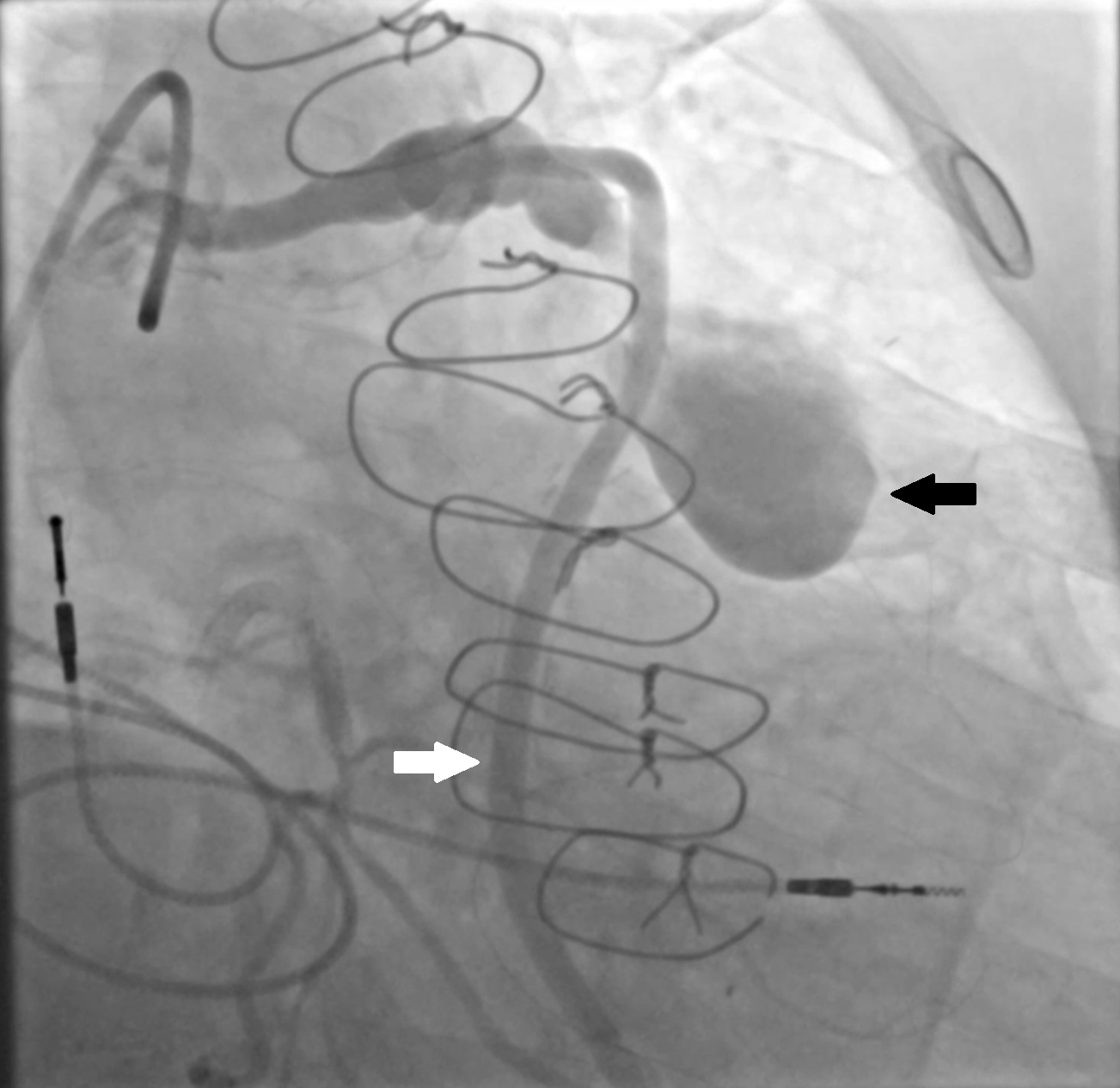 Figure 1. Baseline coronary angiography revealed a large aneurysm of the saphenous vein graft 