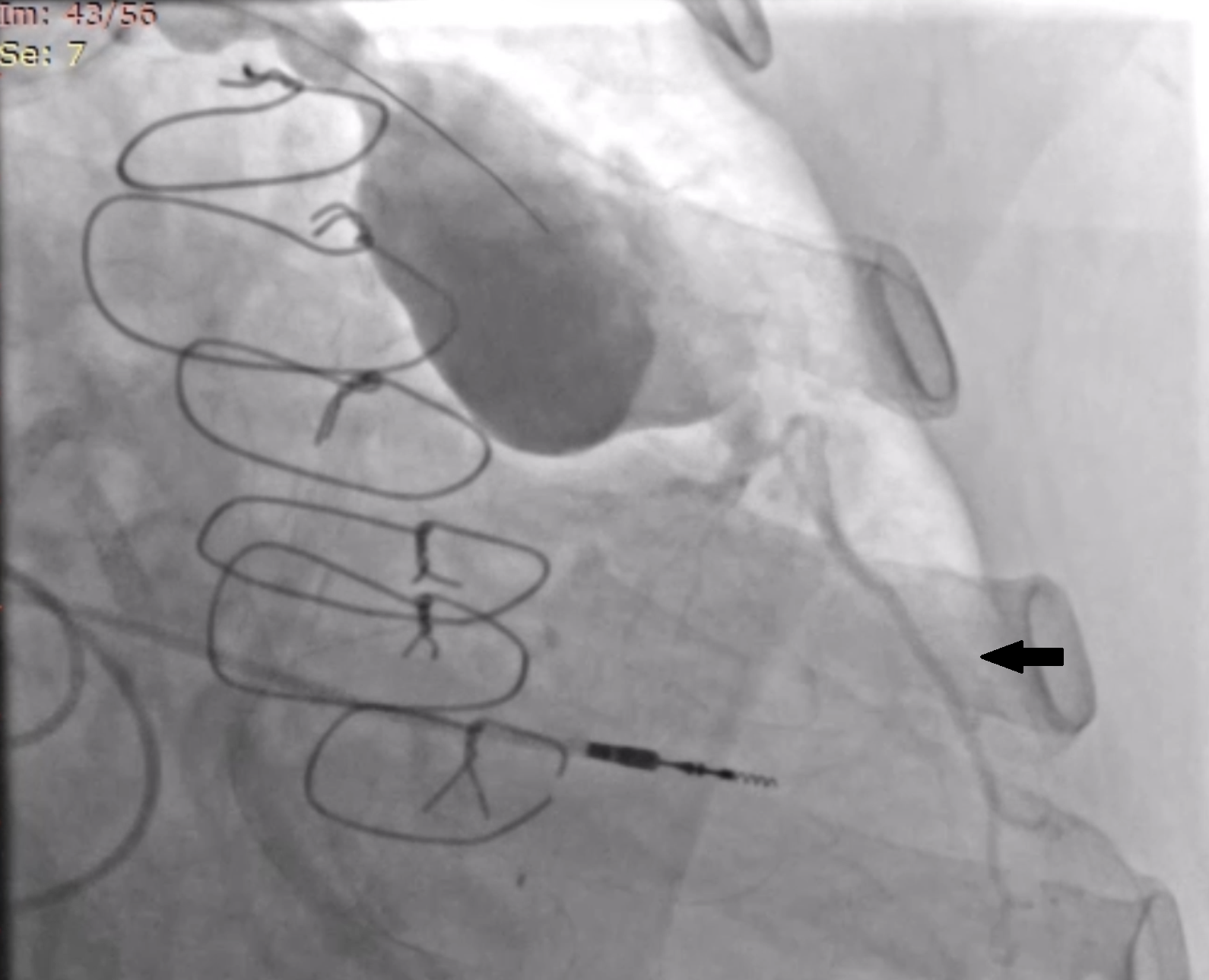 Figure 2. Through a left coronary bypass guide catheter, a guide extension catheter was advanced inside the aneurysm sack