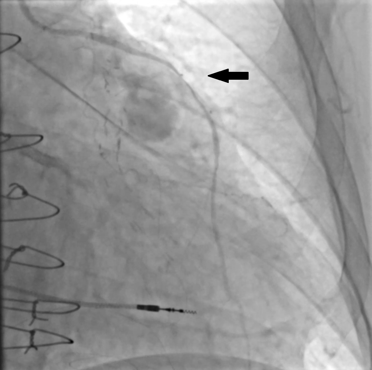 Figure 3. Possible external compression of the left internal mammary artery graft