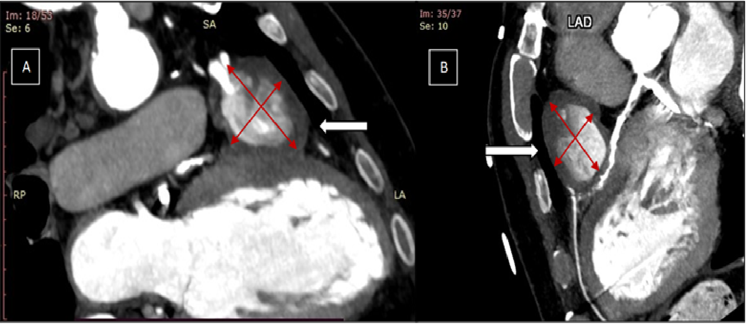 Figure 4. (A) Coronary computed tomography angiography