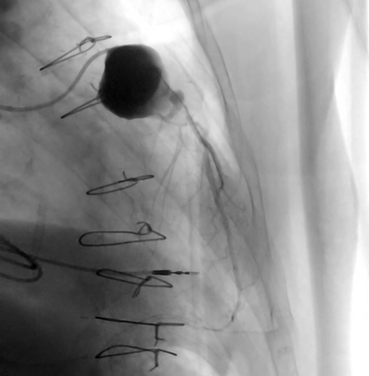 Figure 5. Using a 6F guide extension catheter 