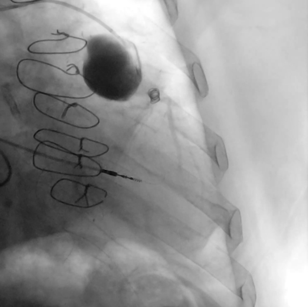 Figure 6. A 4.0 x 10-mm peripheral vessel coil was deployed