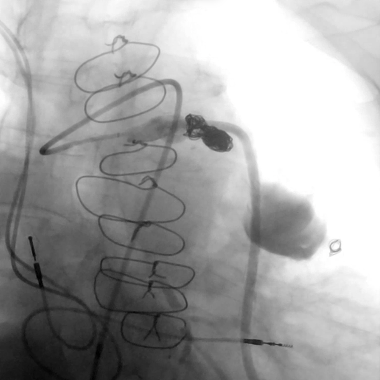 Figure 7. Multiple peripheral vessel coils were deployed
