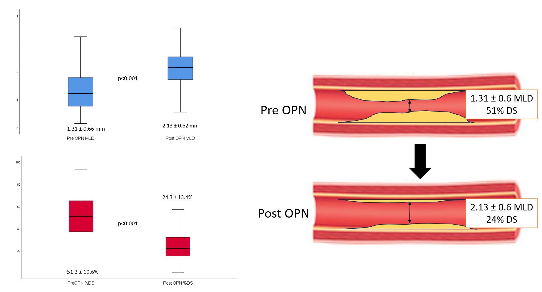 Figure 3. Quantitative coronary angiography analysis