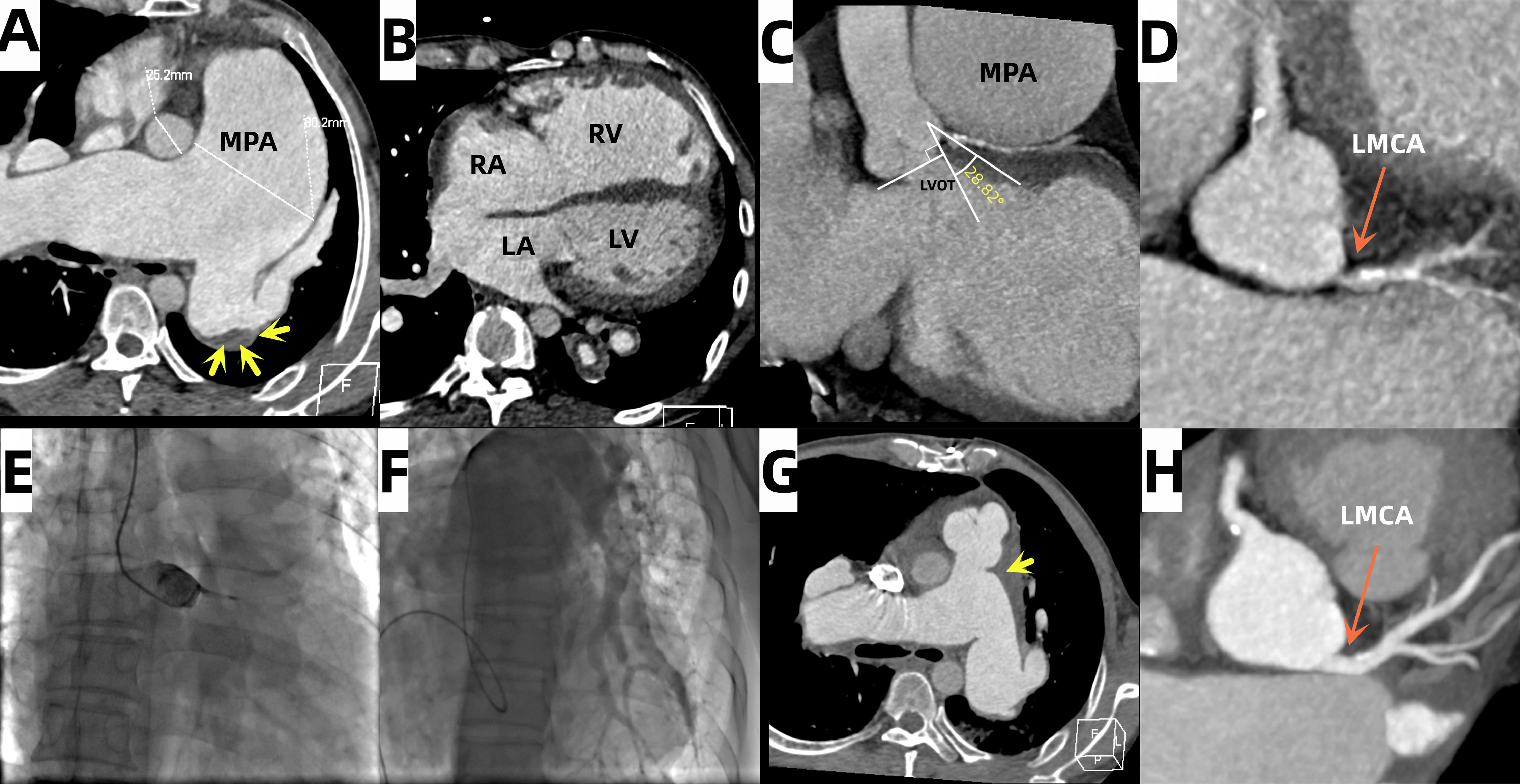 Figure. (A, B) The computed tomography scan 