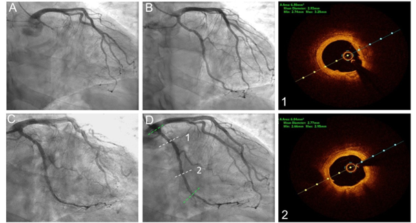 Figure 4. Angiographic and OCT findings