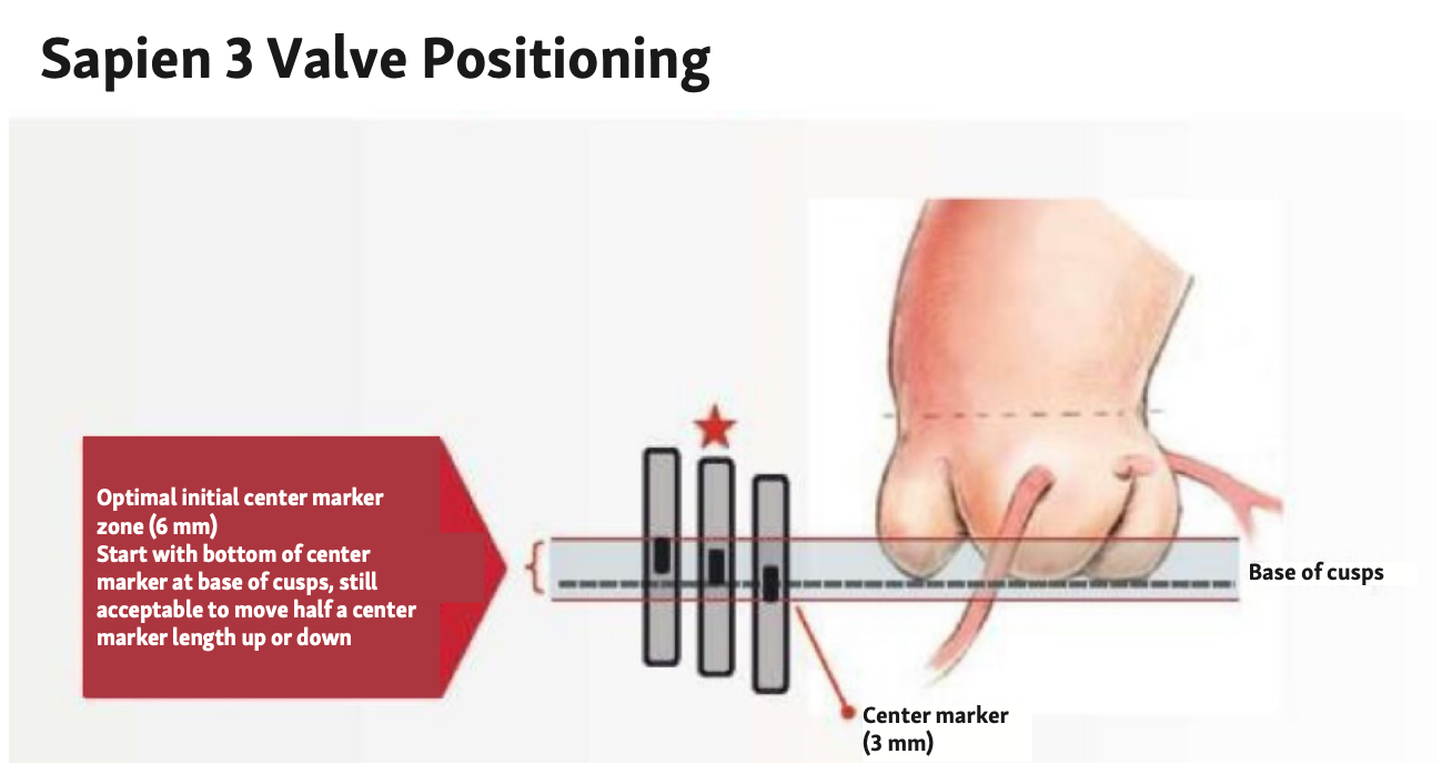 Mailey Transcatheter Figure 1