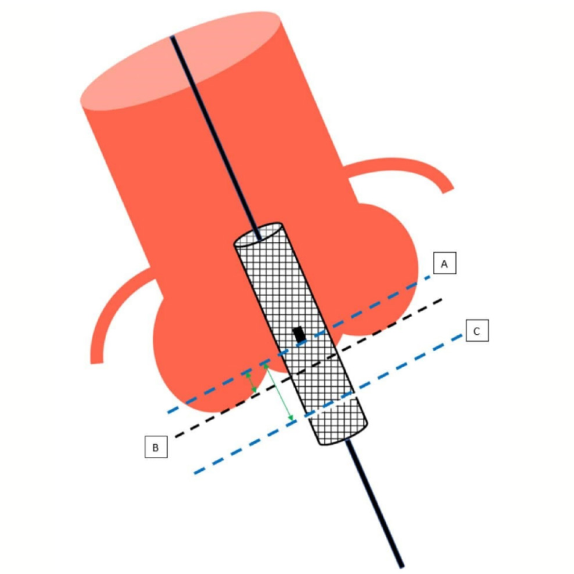 Mailey Transcatheter Figure 3