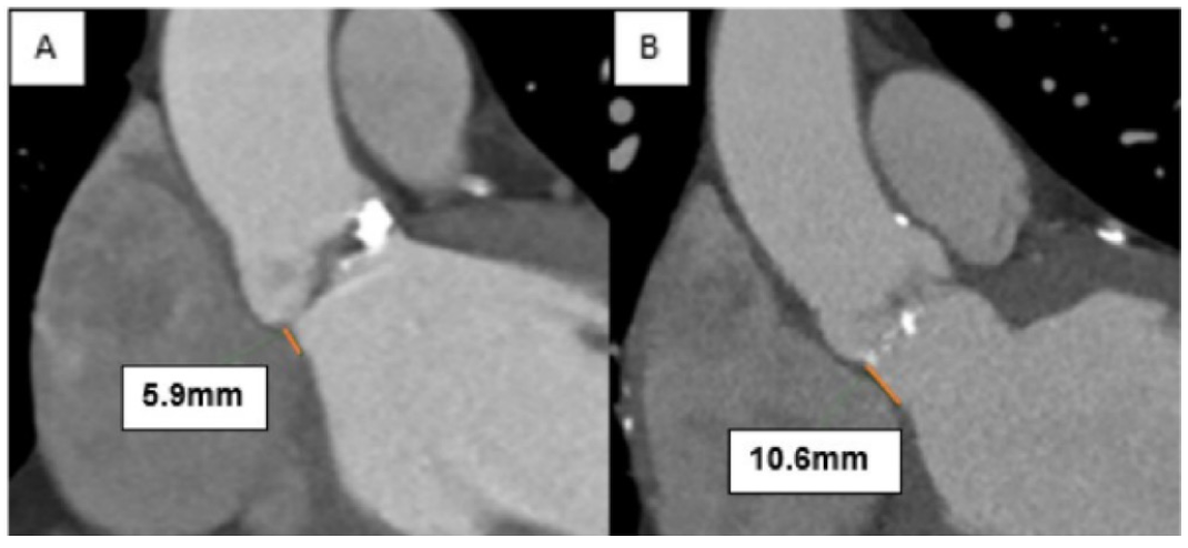 Mailey Transcatheter Figure 5