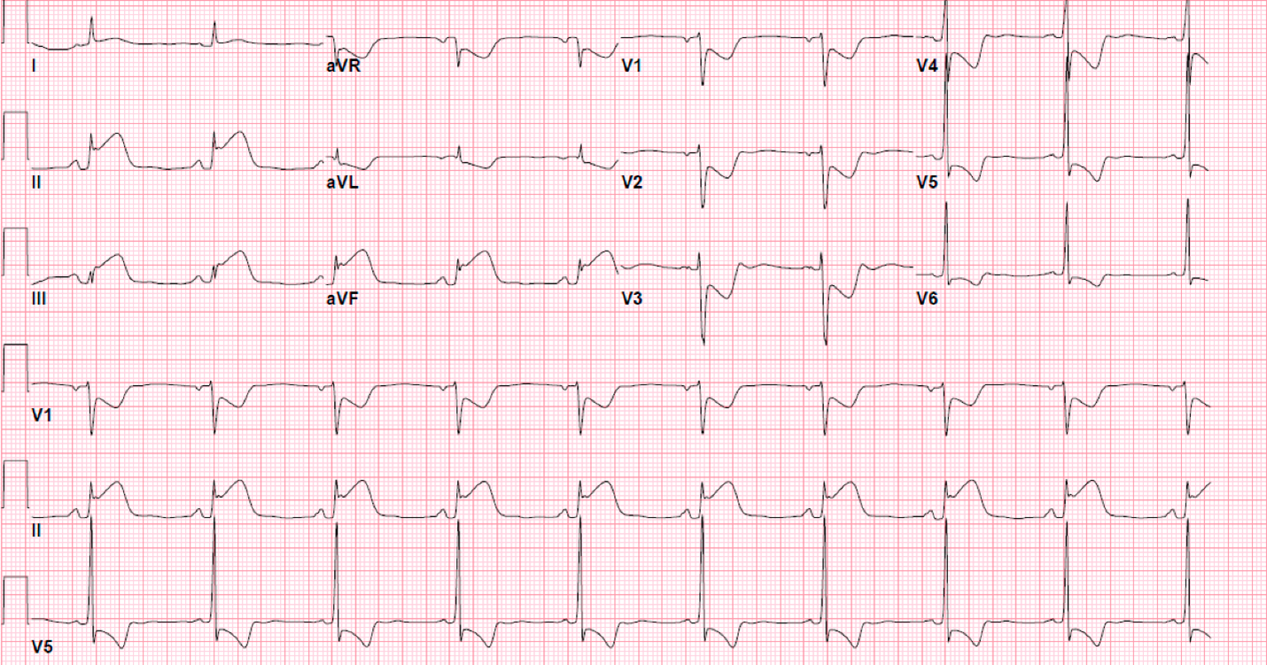 Figure. Electrocardiogram 