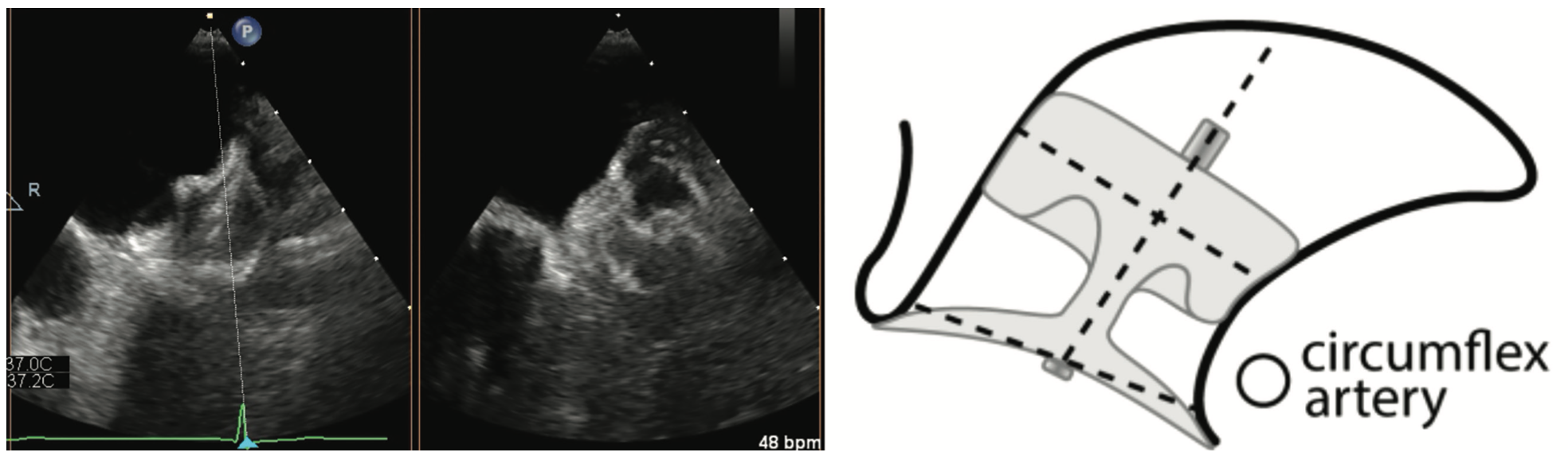 Manyam Left Atrial Appendage Figure 2
