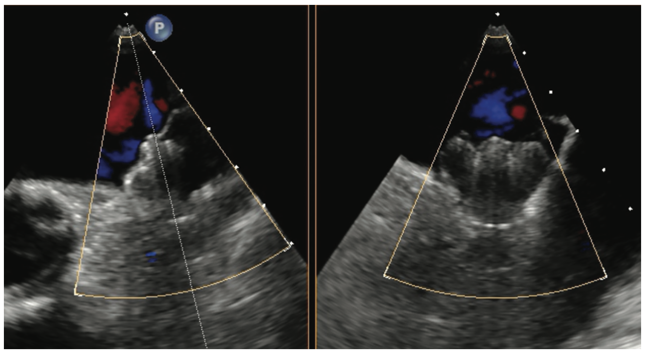 Manyam Left Atrial Appendage Figure 3