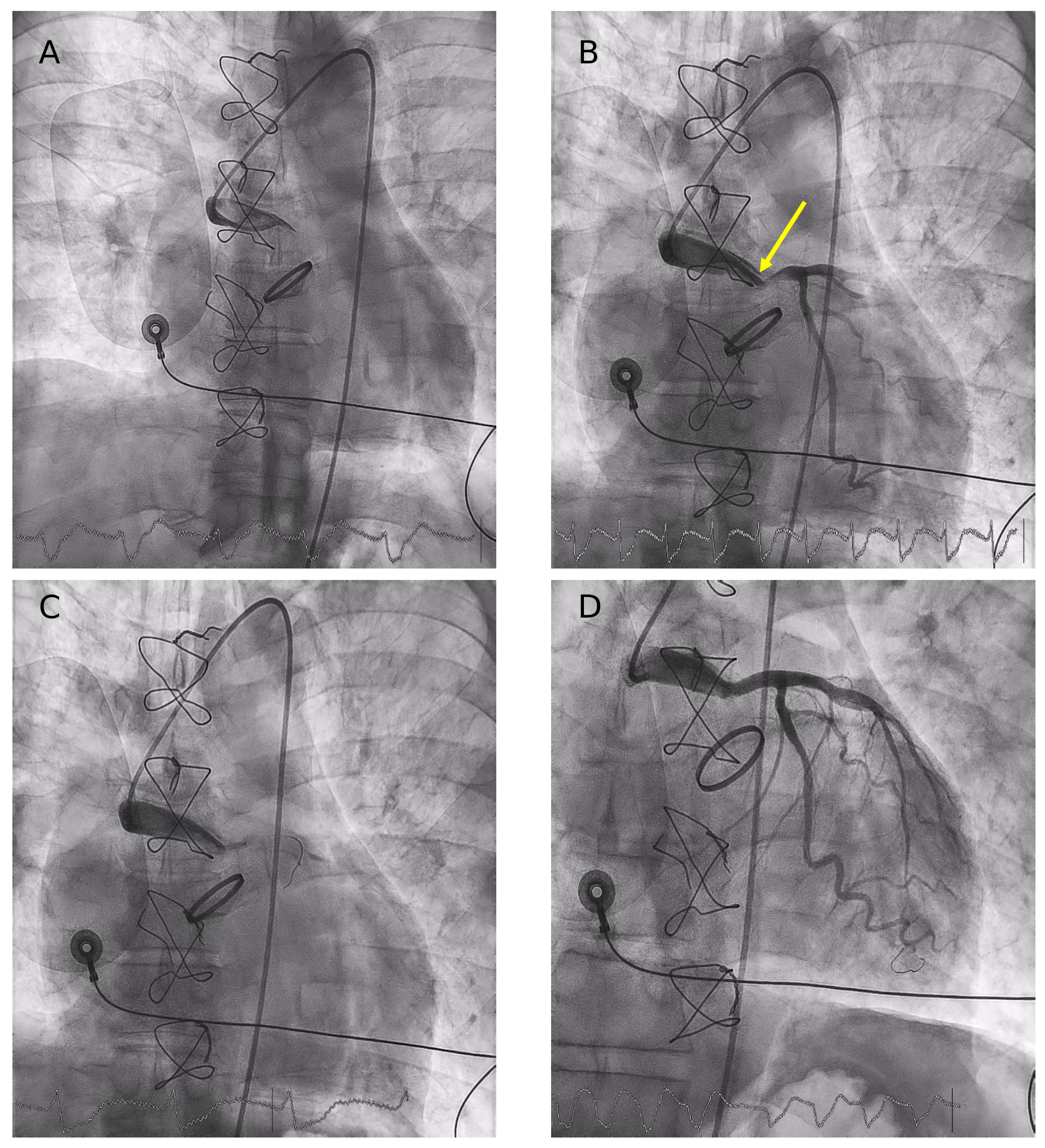 Figure 1. Emergent coronary angiography