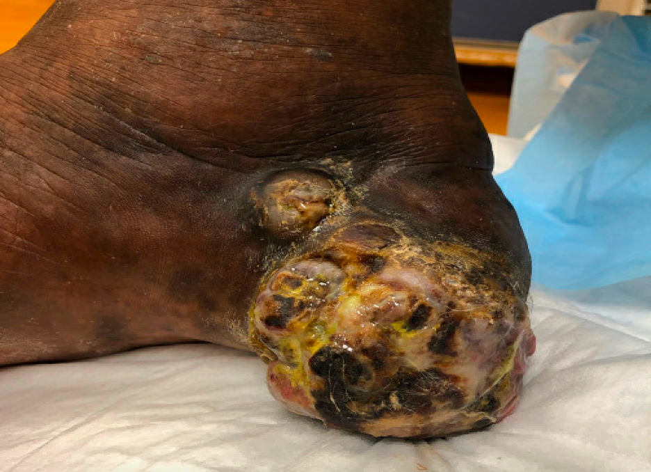 Malignant Melanoma