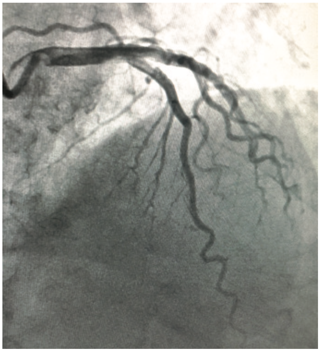 McDonald Coronary Bridging Figure 1