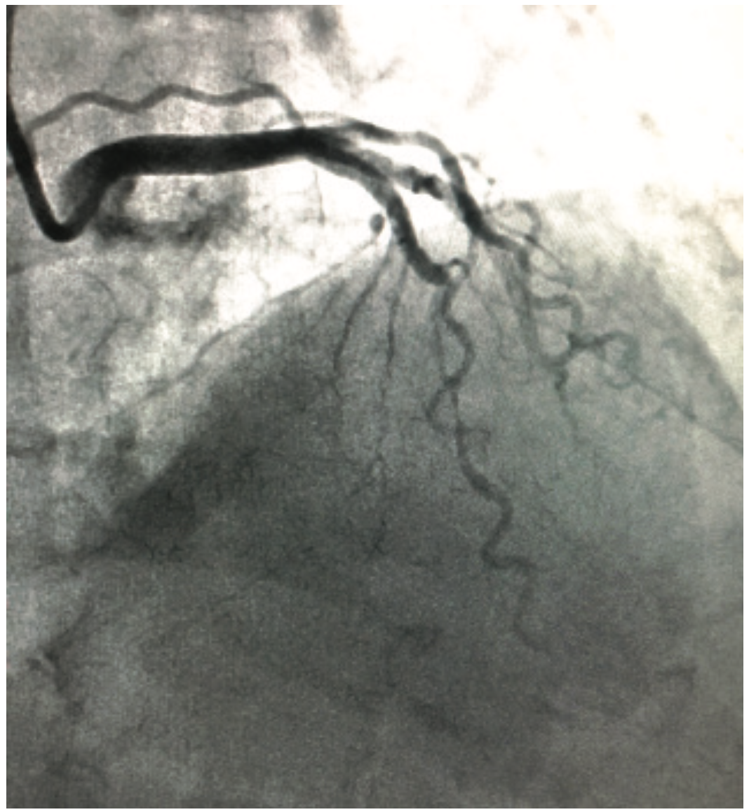 McDonald Coronary Bridging Figure 2