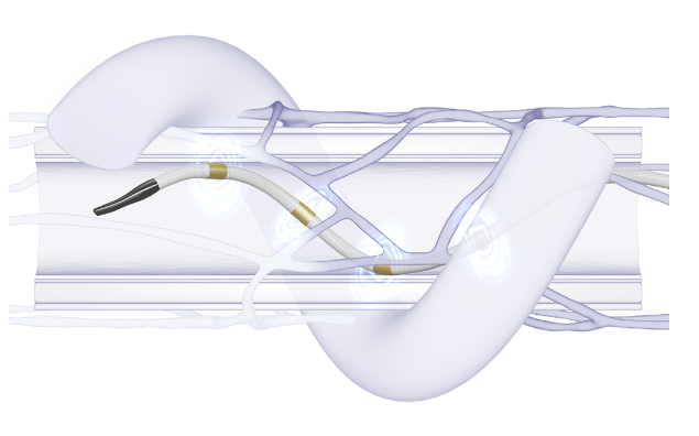 Symplicity Spyral renal denervation