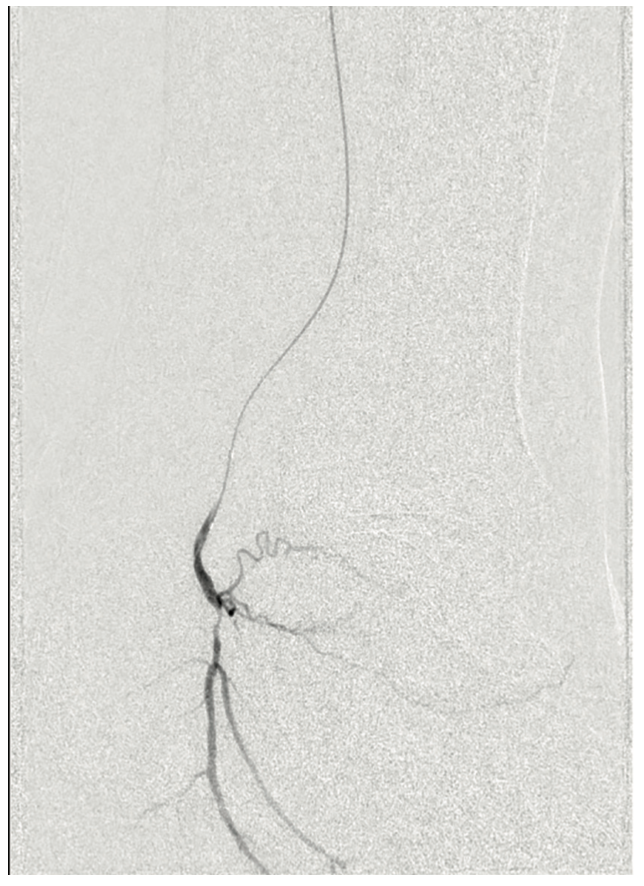 Meisner Serranator PTA Figure 2