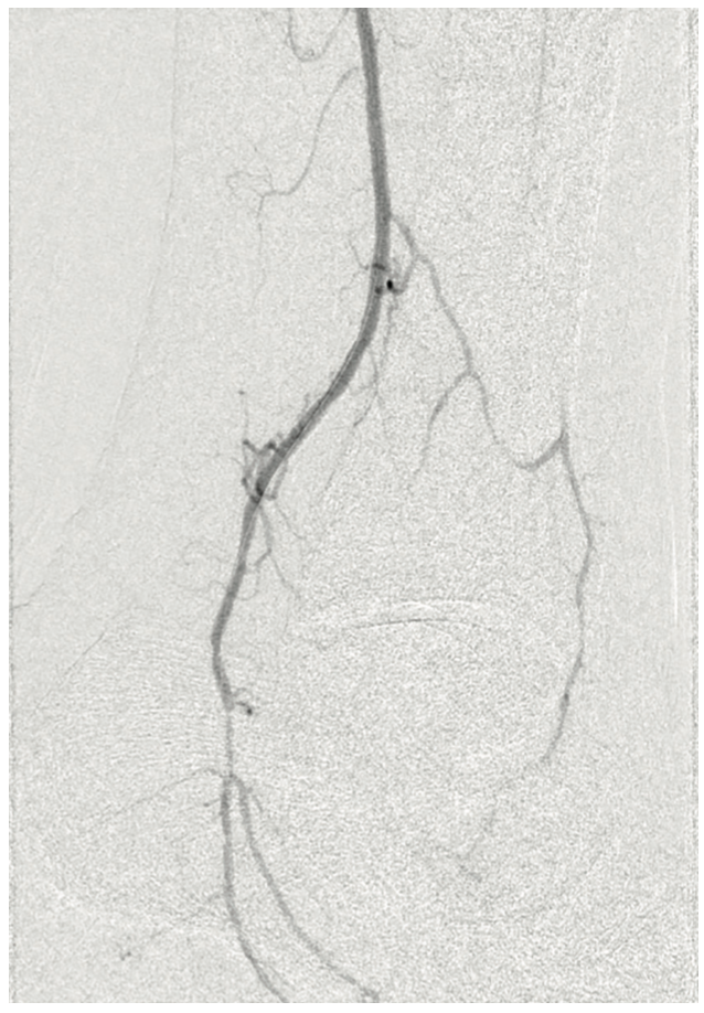 Meisner Serranator PTA Figure 4