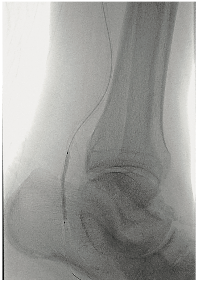 Meisner Serranator PTA Figure 5