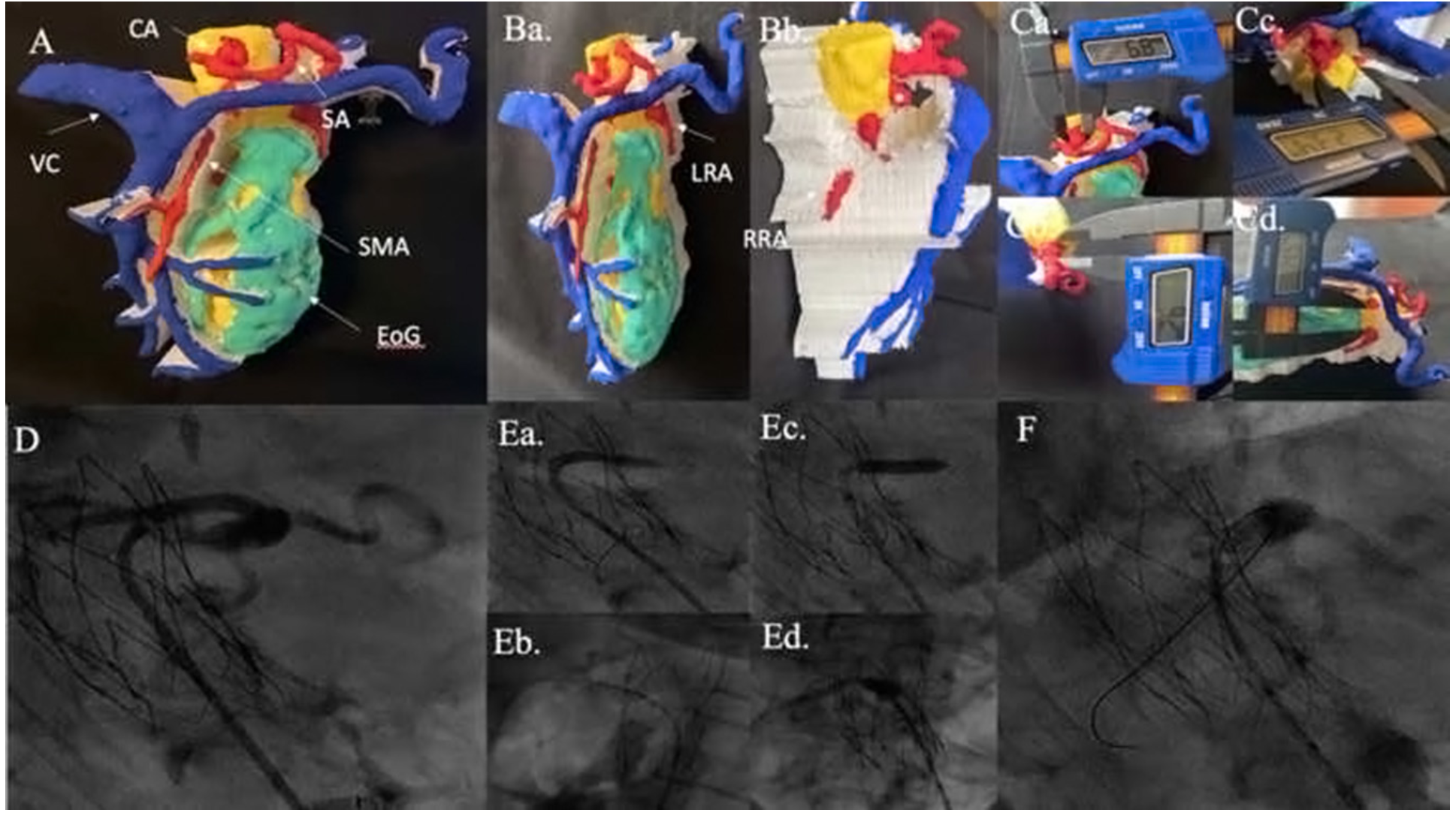 Memon Mesenteric Artery Figure 3