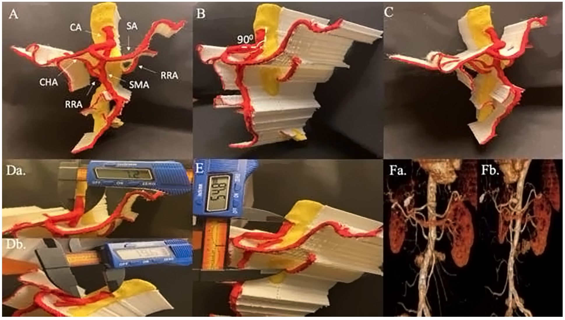 Memon Mesenteric Artery Figure 5