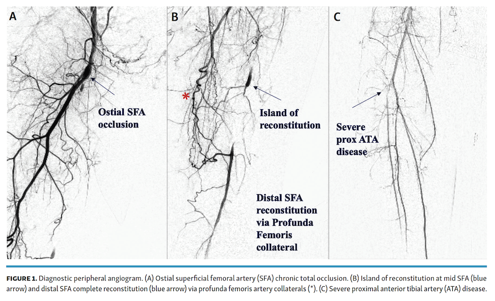 Memon Ostial SFA Fig 1