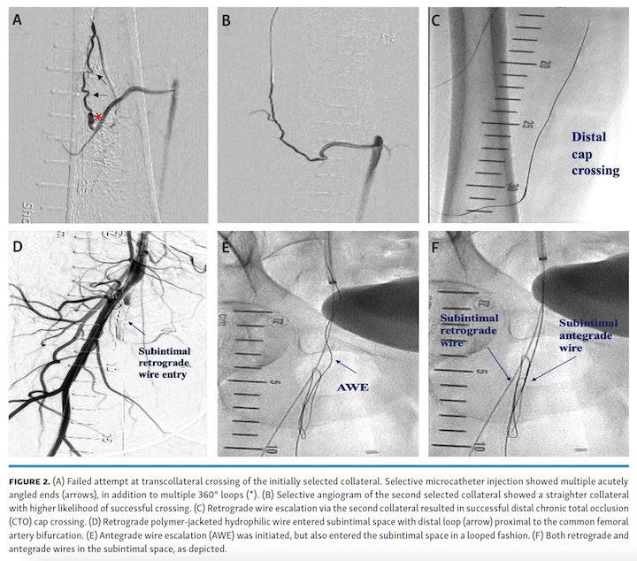 Memon Ostial SFA Fig 2