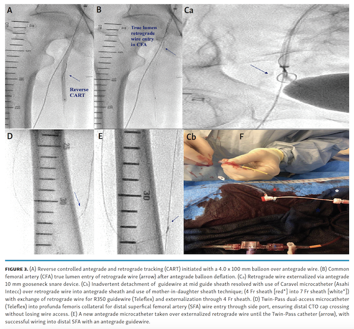 Memon Ostial SFA Fig 3