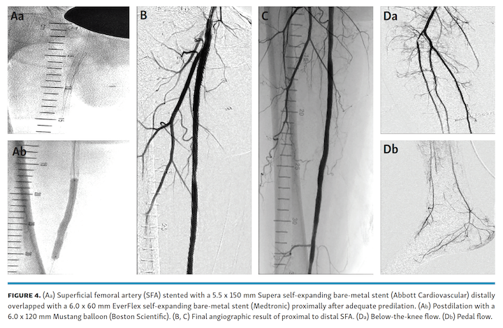 Memon Ostial SFA Fig 4