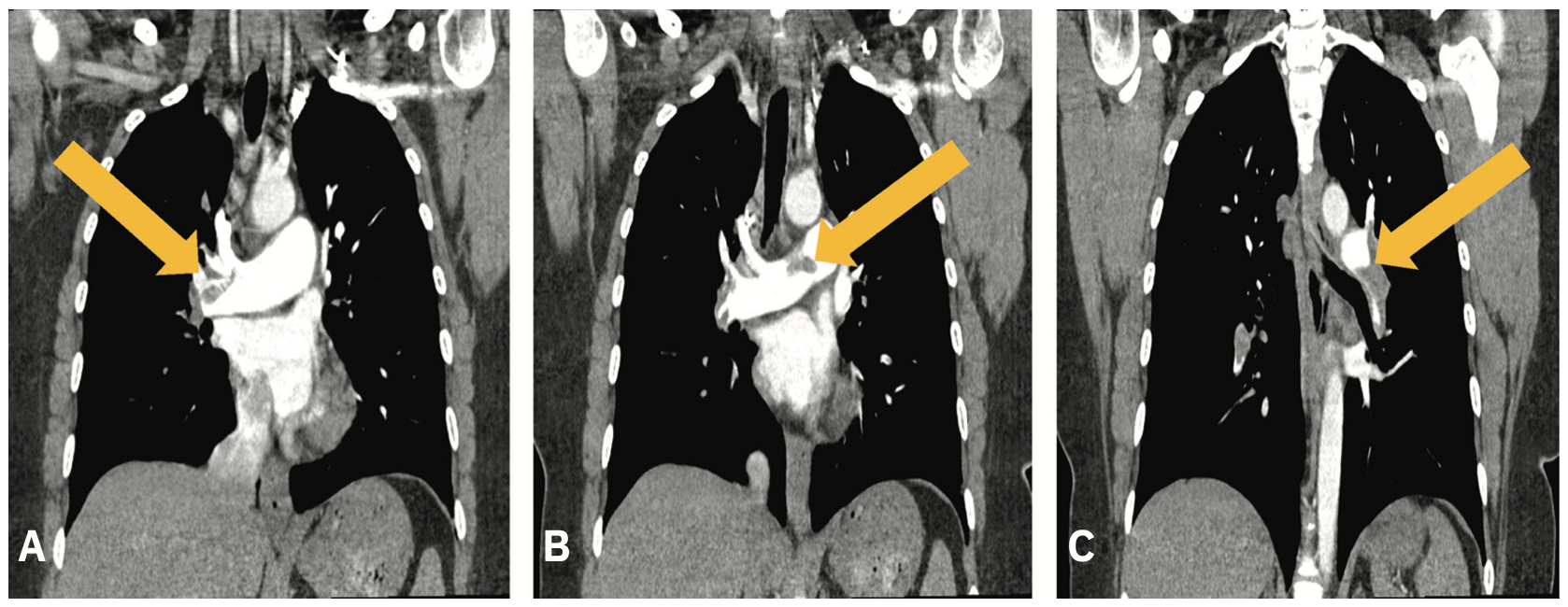 Merchen Pulmonary Embolism Figure 1