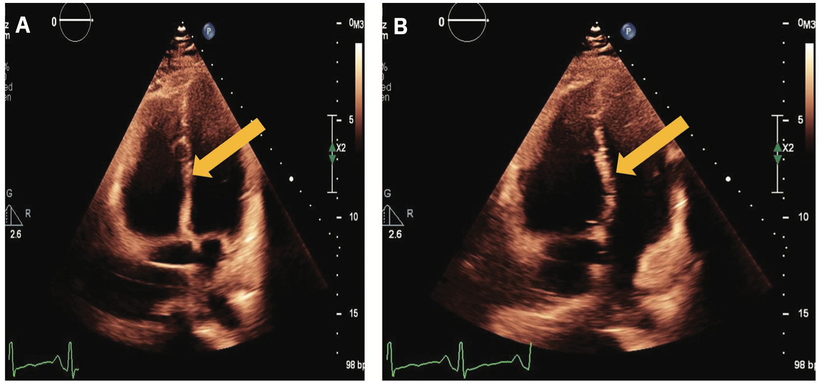 Merchen Pulmonary Embolism Figure 2