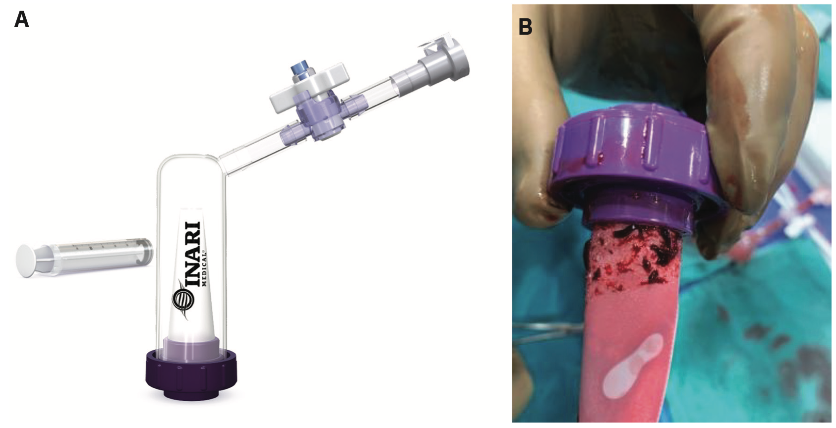 Merchen Pulmonary Embolism Figure 4