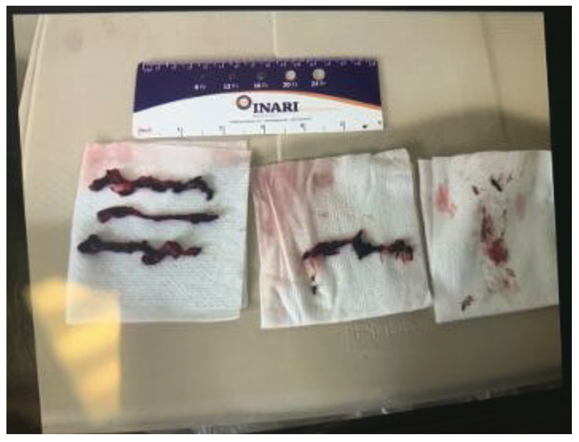 Merchen Pulmonary Embolism Figure 7
