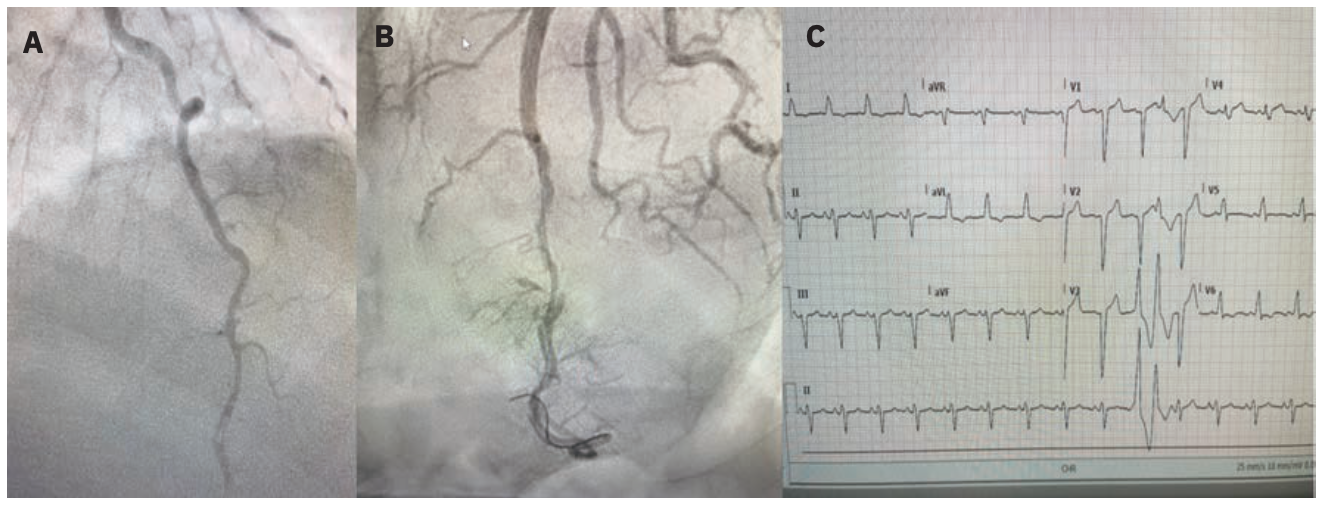 Merschen Coronary Artery Figure 2
