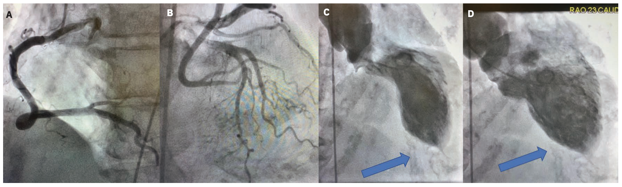 Merschen Coronary Artery Figure 3