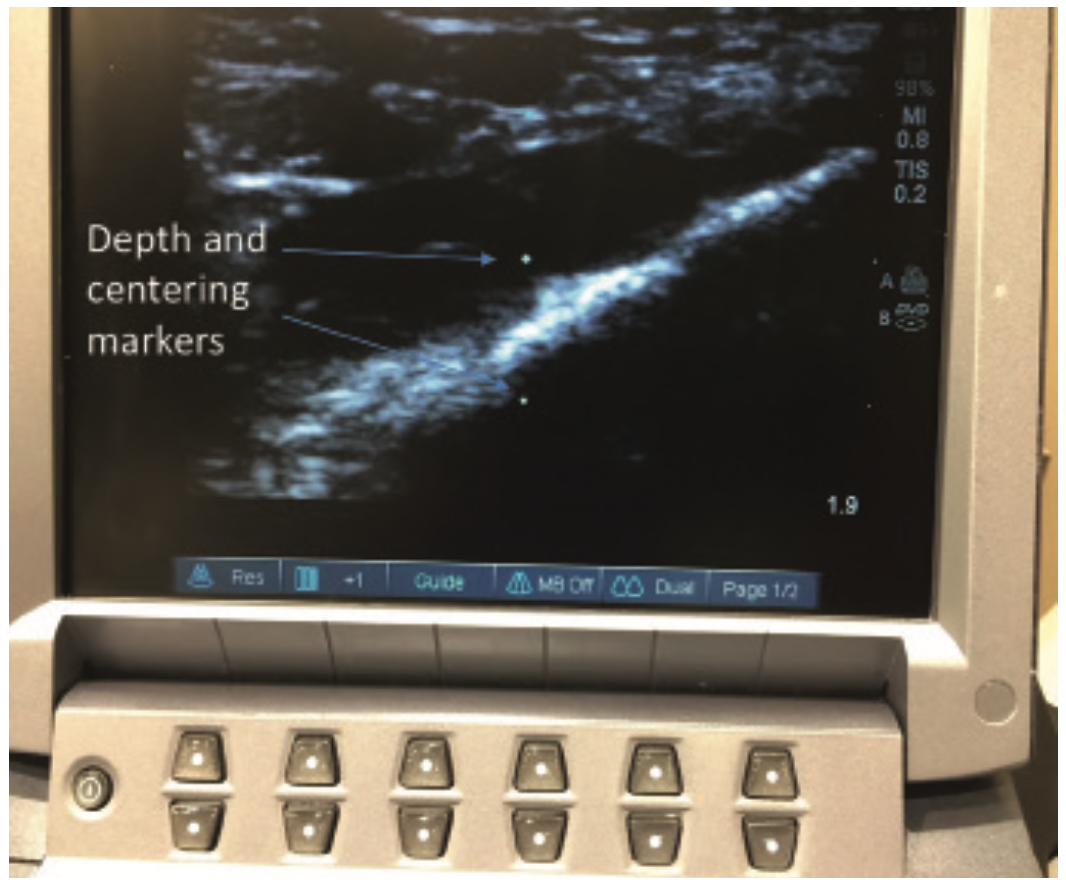 Merschen Vascular Access Figure 1