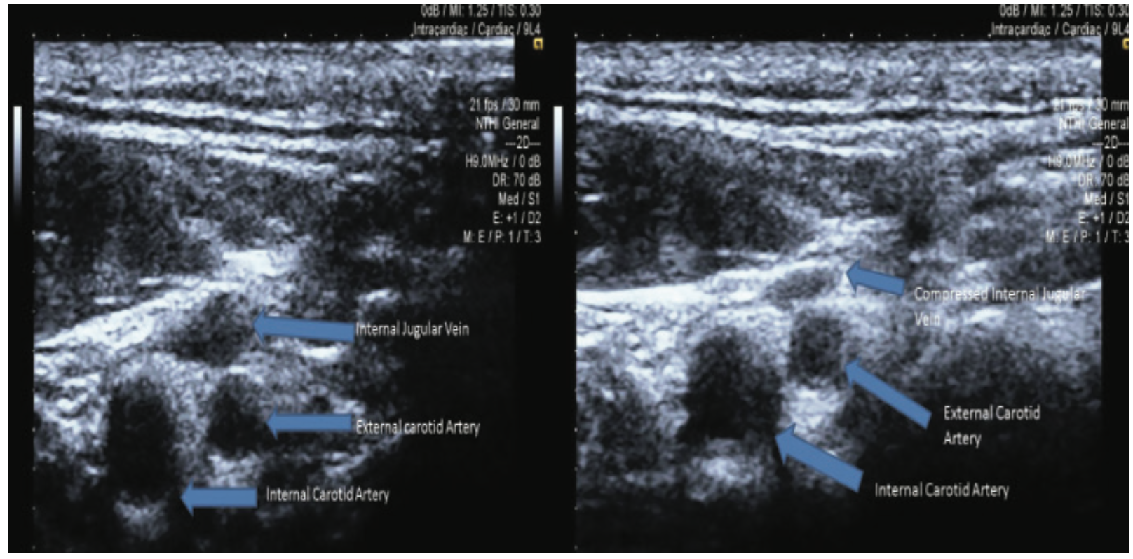 Merschen Vascular Access Figure 3