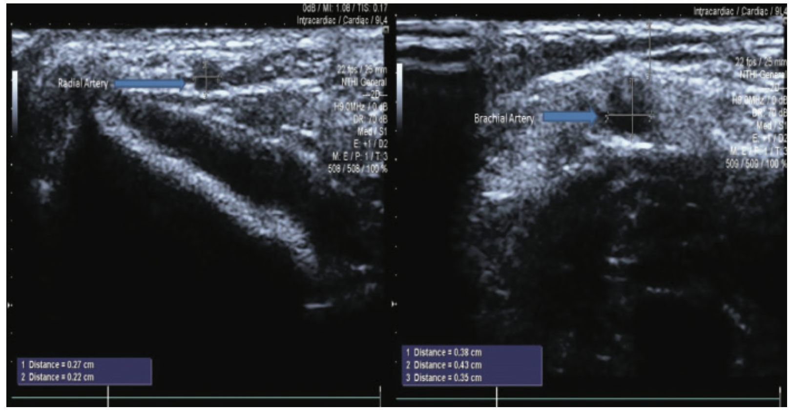 Merschen Vascular Access Figure 5