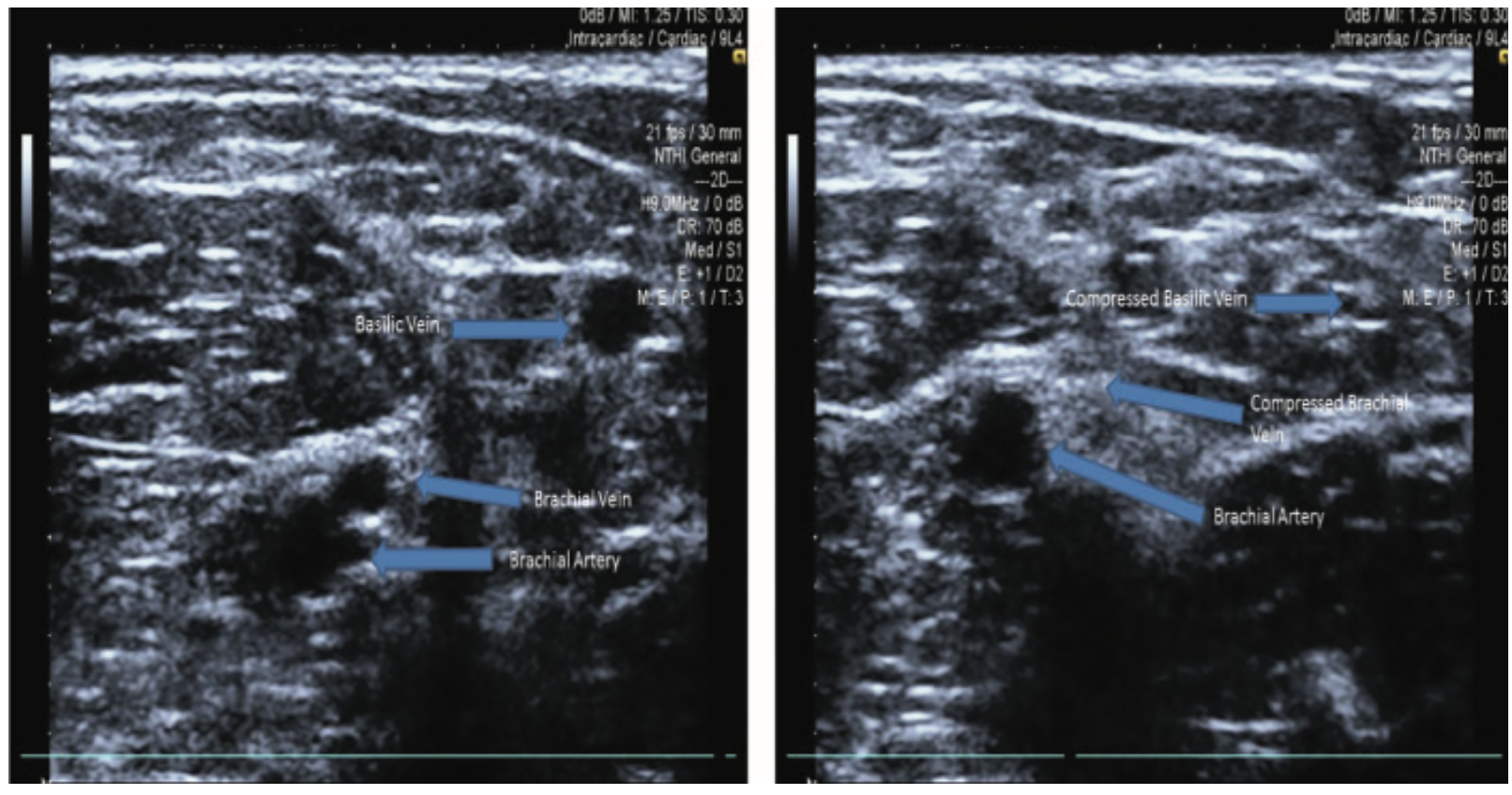 Merschen Vascular Access Figure 6