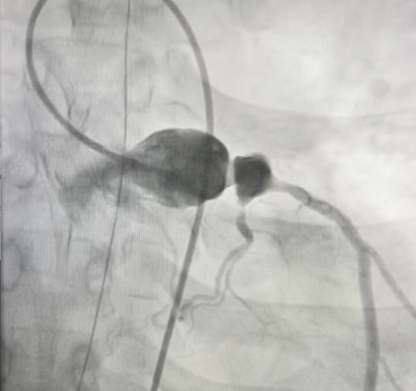 Figure. Saccular aneurysm
