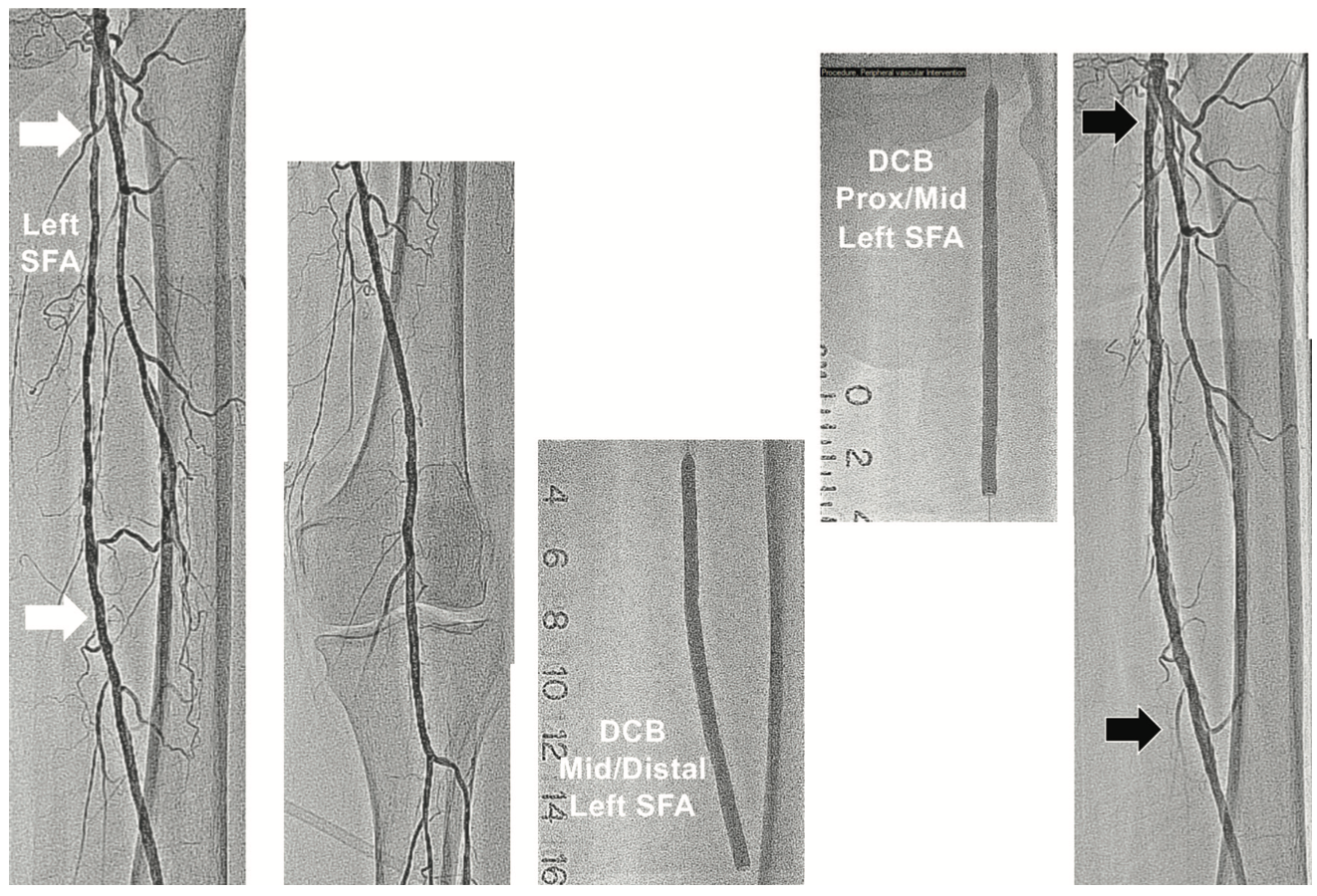 Minor Endovascular Therapy Figure 1