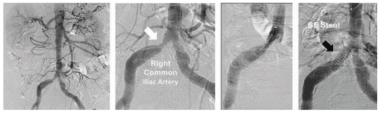 Minor Endovascular Therapy Figure 3A